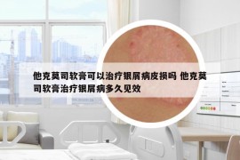 他克莫司软膏可以治疗银屑病皮损吗 他克莫司软膏治疗银屑病多久见效