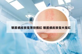 银屑病皮损变薄但很红 银屑病皮损变大变红