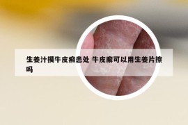 生姜汁摸牛皮癣患处 牛皮廨可以用生姜片擦吗