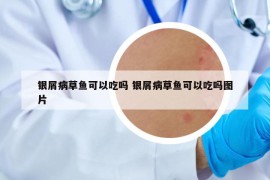 银屑病草鱼可以吃吗 银屑病草鱼可以吃吗图片