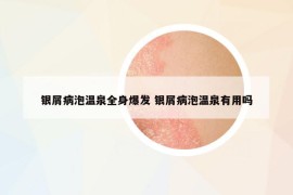 银屑病泡温泉全身爆发 银屑病泡温泉有用吗