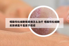 嗜酸性粒细胞银屑病怎么治疗 嗜酸性粒细胞皮肤病是不是属于癌症