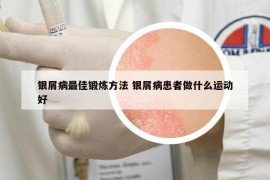 银屑病最佳锻炼方法 银屑病患者做什么运动好