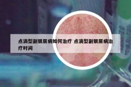 点滴型副银屑病如何治疗 点滴型副银屑病治疗时间