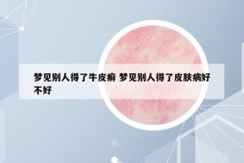 梦见别人得了牛皮癣 梦见别人得了皮肤病好不好