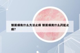 银屑病有什么方法止痒 银屑病用什么药能止痒?