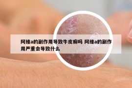 阿维a的副作用导致牛皮癣吗 阿维a的副作用严重会导致什么