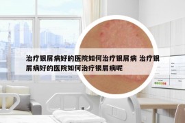 治疗银屑病好的医院如何治疗银屑病 治疗银屑病好的医院如何治疗银屑病呢