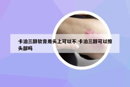 卡泊三醇软膏用头上可以不 卡泊三醇可以擦头部吗