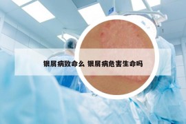 银屑病致命么 银屑病危害生命吗