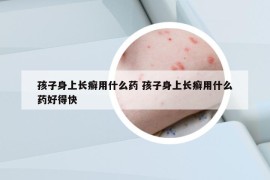 孩子身上长癣用什么药 孩子身上长癣用什么药好得快