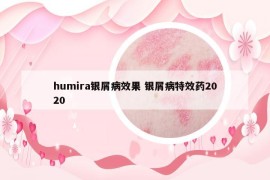 humira银屑病效果 银屑病特效药2020