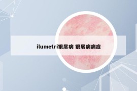 ilumetri银屑病 银屑病病症