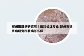 郑州银屑病研究院來请刘长江专业 郑州市银屑病研究所看病怎么样