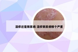 湿疹还是银屑病 湿疹银屑病哪个严重