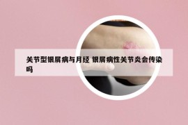 关节型银屑病与月经 银屑病性关节炎会传染吗