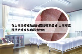 在上海治疗皮肤病的医院哪家最好 上海哪家医院治疗皮肤病最有效的