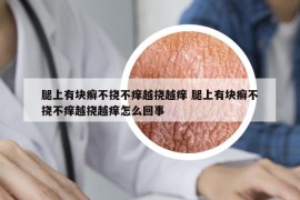 腿上有块癣不挠不痒越挠越痒 腿上有块癣不挠不痒越挠越痒怎么回事