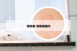 钱班癣 钱斑癣图片