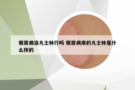 银屑病涂凡士林行吗 银屑病用的凡士林是什么样的