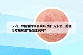 卡泊三醇能治好银屑病吗 为什么卡泊三醇能治疗银屑病?是激素药吗?