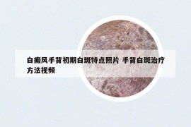 白癜风手背初期白斑特点照片 手背白斑治疗方法视频