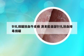 针扎拔罐放血牛皮癣 激素脸面部针扎放血排毒拔罐