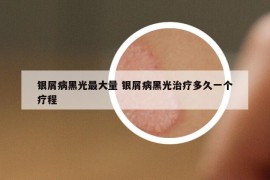 银屑病黑光最大量 银屑病黑光治疗多久一个疗程