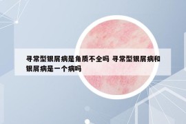 寻常型银屑病是角质不全吗 寻常型银屑病和银屑病是一个病吗