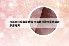 阿莫西林胶囊皮肤病 阿莫西林治疗皮肤病最多用几天