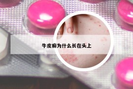 牛皮癣为什么长在头上