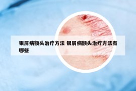 银屑病额头治疗方法 银屑病额头治疗方法有哪些