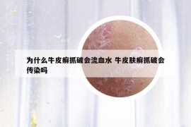 为什么牛皮癣抓破会流血水 牛皮肤癣抓破会传染吗