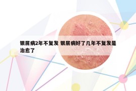 银屑病2年不复发 银屑病好了几年不复发是治愈了