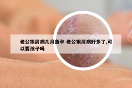 老公银屑病几月备孕 老公银屑病好多了,可以要孩子吗