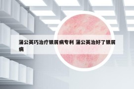 蒲公英巧治疗银屑病专利 蒲公英治好了银屑病