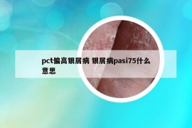 pct偏高银屑病 银屑病pasi75什么意思