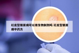 红皮型银屑病可以用生物制剂吗 红皮型银屑病中药方