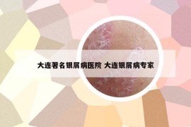 大连著名银屑病医院 大连银屑病专家