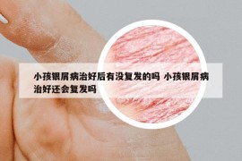 小孩银屑病治好后有没复发的吗 小孩银屑病治好还会复发吗