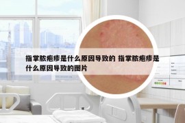 指掌脓疱疹是什么原因导致的 指掌脓疱疹是什么原因导致的图片