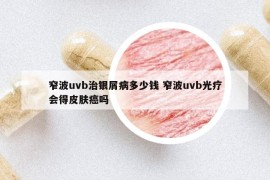 窄波uvb治银屑病多少钱 窄波uvb光疗会得皮肤癌吗