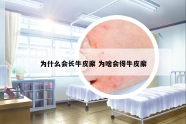 为什么会长牛皮廨 为啥会得牛皮廨