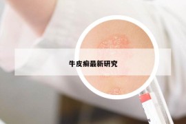 牛皮癣最新研究