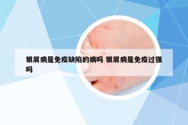 银屑病是免疫缺陷的病吗 银屑病是免疫过强吗