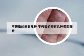 不传染的癣有几种 不传染的癣有几种类型图片