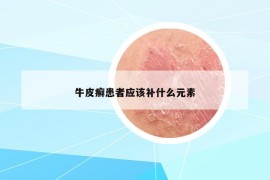 牛皮癣患者应该补什么元素