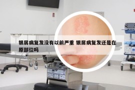 银屑病复发没有以前严重 银屑病复发还是在原部位吗