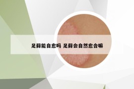 足藓能自愈吗 足藓会自然愈合嘛