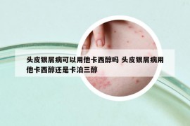 头皮银屑病可以用他卡西醇吗 头皮银屑病用他卡西醇还是卡泊三醇